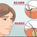 Livre-se das manchas vermelhas da acne
