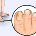 Livre-se das unhas fúngicas
