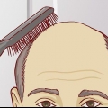 Saiba se você tem calvície de padrão masculino clássico
