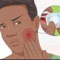 Saiba quando suas obturações dentárias precisam ser substituídas