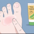 Curar o eczema do nadador: pode ser feito naturalmente?