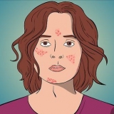 Remédio acne com formação de cisto