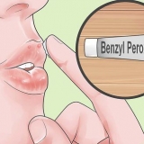 Trate rapidamente a acne ao redor dos lábios