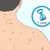 Livre-se das cicatrizes de acne nas costas