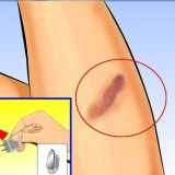 Usando aloe vera para tratar queimaduras