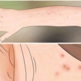 Combate aos percevejos de cama