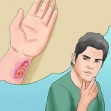 Prevenir o botulismo