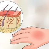 Tratamento de queimaduras por água quente