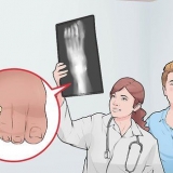 Enfaixando um dedo quebrado