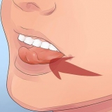Perder um dente solto sem puxá-lo