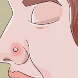 Tratando um piercing no nariz inflamado