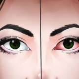 Tratando uma infecção ocular naturalmente