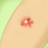Tratamento de uma infecção estafilocócica