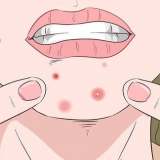 Reconhecendo uma infecção estafilocócica