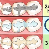Cuidar de uma obturação em um dente ou molar