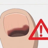 Como tratar uma unha preta