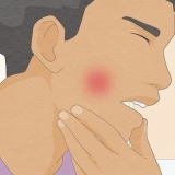 Prevenir e curar cáries em seus dentes