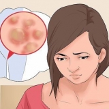 Tratamento de verrugas genitais em mulheres