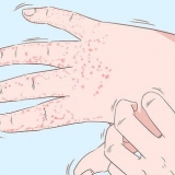Tratamento de eczema nas mãos
