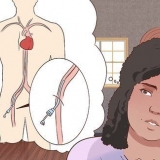 Recuperando-se de uma angiografia