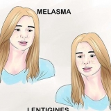 Tratamento da hiperpigmentação