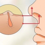 Tratamento de pelos do nariz encravados