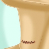 Cuidando da sua incisão após a cirurgia da tireoide