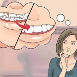Preparando-se para o dia em que você colocar o aparelho