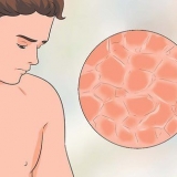Tratando os seios com coceira