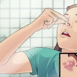 Tratamento de herpes labial no nariz
