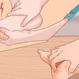 Tratamento de pés de trincheira