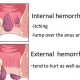 Como se livrar das hemorroidas naturalmente