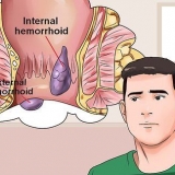 Como curar hemorróidas dolorosas