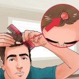 Como tratar a micose no couro cabeludo