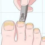 Tratamento de unhas fúngicas