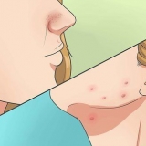 Livre-se da acne de forma rápida e natural