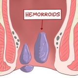 Usando hamamélis para tratar hemorroidas