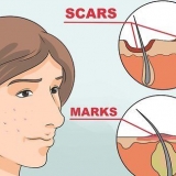 Livre-se das manchas vermelhas da acne