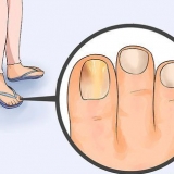 Livre-se das unhas fúngicas