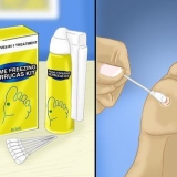 Remover verrugas nos pés