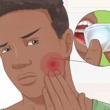 Saiba quando suas obturações dentárias precisam ser substituídas