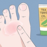 Curar o eczema do nadador: pode ser feito naturalmente?