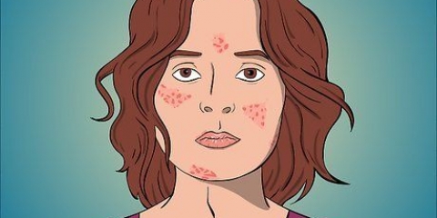 Remédio acne com formação de cisto