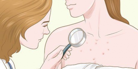 Livre-se das cicatrizes de acne no peito
