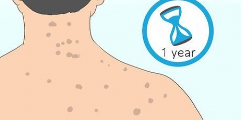 Livre-se das cicatrizes de acne nas costas