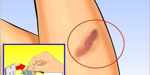 Usando aloe vera para tratar queimaduras