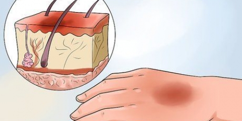 Tratamento de queimaduras