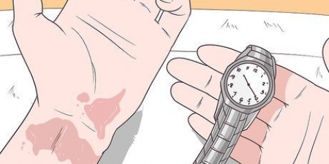 Tratamento de queimaduras de vinagre de maçã
