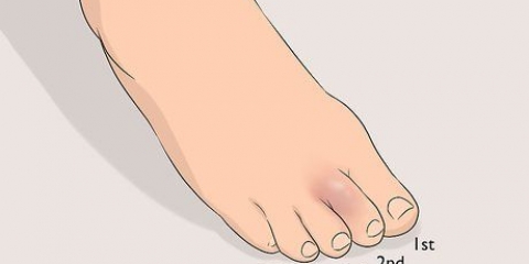 Usando fita adesiva para um dedo do pé lesionado