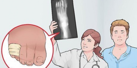 Enfaixando um dedo quebrado